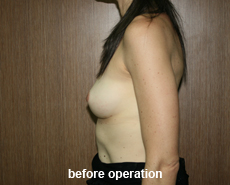 plastic-surgery-breast-augmentation